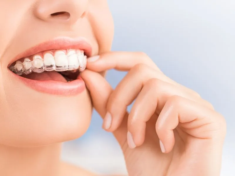 Best Braces & Aligners for Teeth Straightening in Karve Nagar & Baner - My Family Dental Clinic