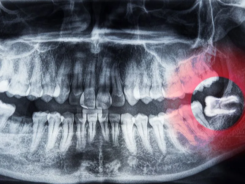 Wisdom Teeth Extraction in Karve Nagar & Baner - My Family Dental Clinic