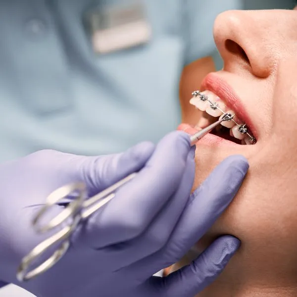 Best Braces & Aligners for Teeth Straightening in Karve Nagar