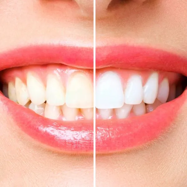 Teeth Cleaning, Whitening & Bleaching in Karve Nagar