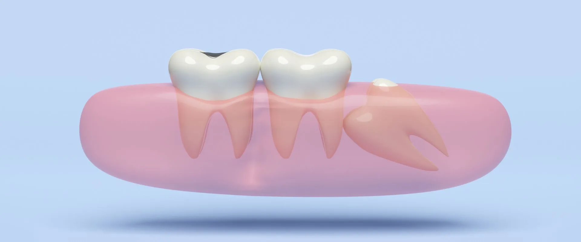 Wisdom Teeth Extraction in Karve Nagar & Kothrud - My Family Dental Clinic