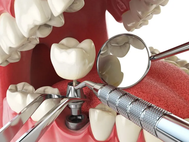 Dental Implants in Karve Nagar & Baner - My Family Dental Clinic