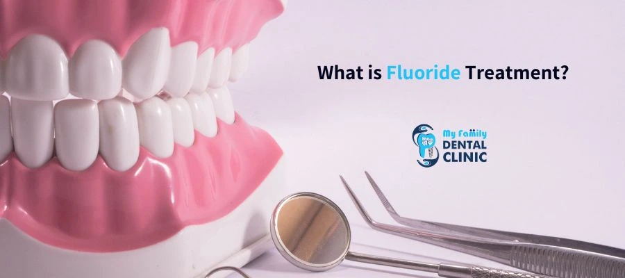 What is Fluoride Treatment Benefits, Process, and How It Protects Your Teeth - My Family Dental Clinic