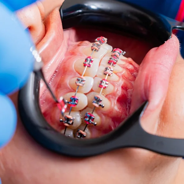 Braces Treatment Near You in Erandwane & Kothrud