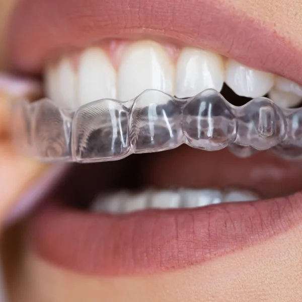 Invisible Teeth Aligners Dentist in Erandwane, Kothrud