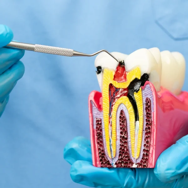 Root Canal Dentist in Erandwane