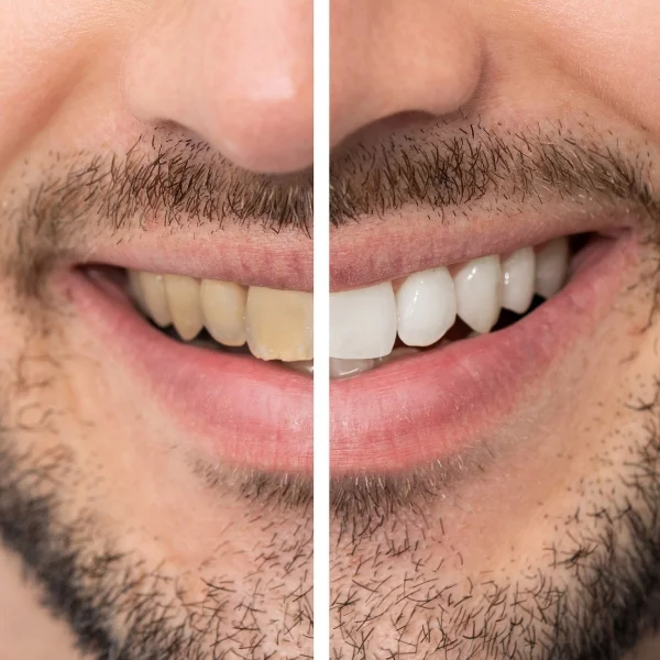 Teeth Whitening Treatment Near Me in Erandwane & Kothrud