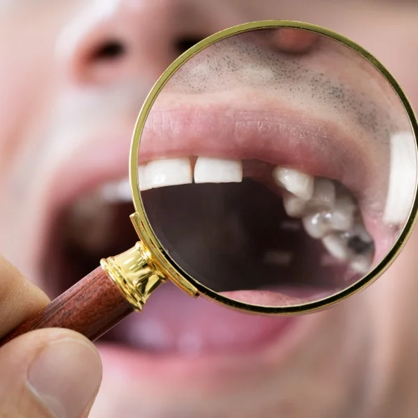 Wisdom Teeth Extraction Near you in Erandwane, Kothrud