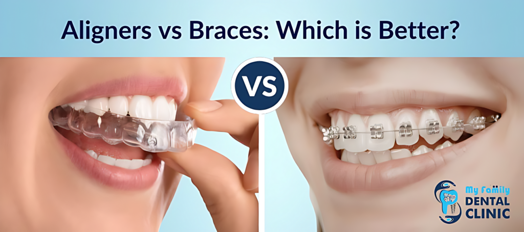 Aligners vs Braces Which Is Better for Teeth Straightening