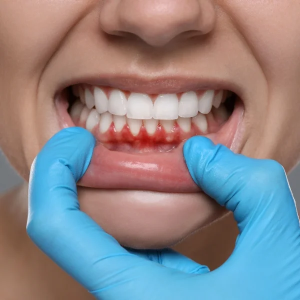 Gum Treatment